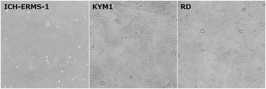横紋筋肉腫 / Rhabdomyosarcoma